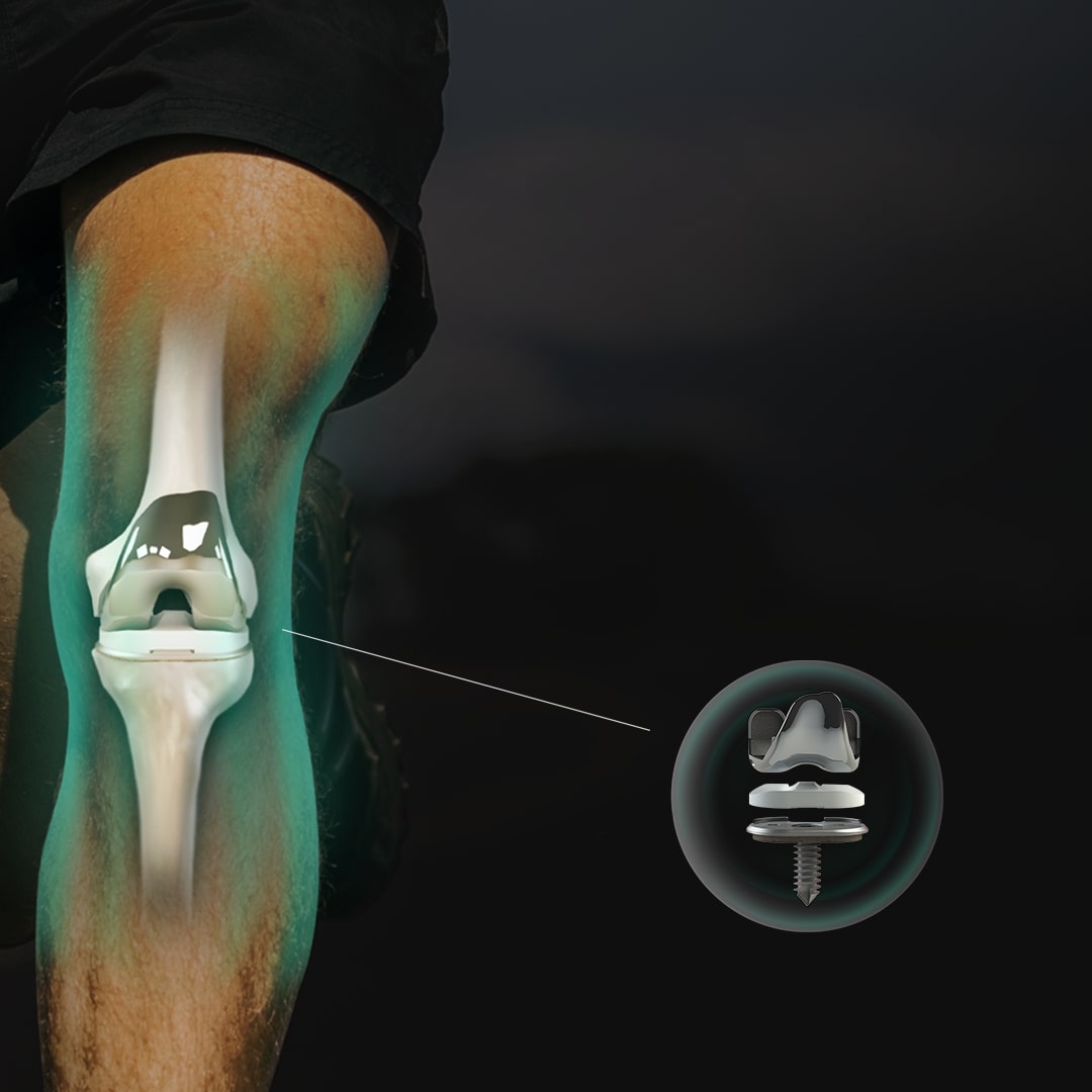 Is Monogram Orthopedics A Good Investment What Is Monogram Orthopedics at Stephanie Dampier blog